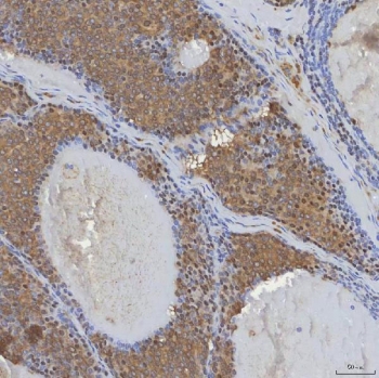 IHC staining of FFPE human breast cancer tissue with mSin3A antibody. HIER: boil tissue sections in pH8 EDTA for 20 min and allow to cool before testing.