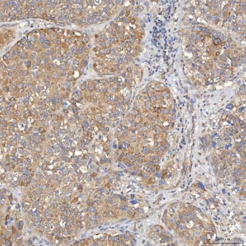 IHC staining of FFPE human liver cancer tissue with SLC20A1 antibody. HIER: boil tissue sections in pH8 EDTA for 20 min and allow to cool before testing.