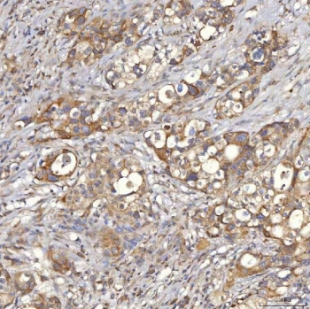 IHC staining of FFPE human appendix adenocarcinoma tissue with SLC25A10 antibody. HIER: boil tissue sections in pH8 EDTA for 20 min and allow to cool before testing.