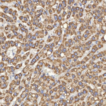 IHC staining of FFPE human liver cancer tissue with SLC25A10 antibody. HIER: boil tissue sections in pH8 EDTA for 20 min and allow to cool before testing.