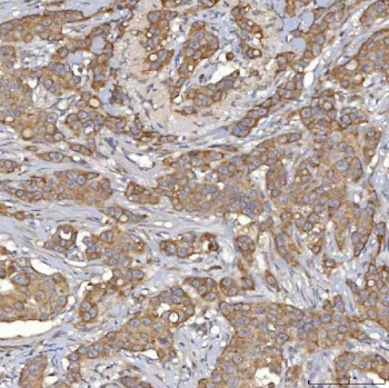 IHC staining of FFPE human breast cancer tissue with SLC25A10 antibody. HIER: boil tissue sections in pH8 EDTA for 20 min and allow to cool before testing.