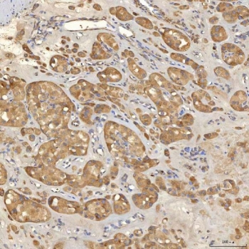 IHC staining of FFPE human right renal oncocytoma tissue with SLC25A10 antibody. HIER: boil tissue sections in pH8 EDTA for 20 min and allow to cool before testing.