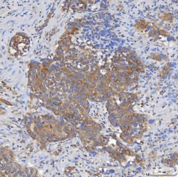 IHC staining of FFPE human urothelial carcinoma tissue with SLC25A10 antibody. HIER: boil tissue sections in pH8 EDTA for 20 min and allow to cool before testing.