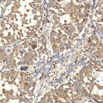 IHC staining of FFPE human lung adenocarcinoma tissue with SLC25A10 antibody. HIER: boil tissue sections in pH8 EDTA for 20 min and allow to cool before testing.