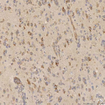 IHC staining of FFPE human glioblastoma tissue with SLC25A10 antibody. HIER: boil tissue sections in pH8 EDTA for 20 min and allow to cool before testing.