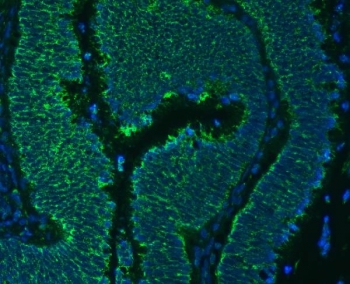 Immunofluorescent staining of FFPE human colon cancer tissue with SLC25A24 antibody (green) and DAPI nuclear stain (blue). HIER: steam section in pH6 citrate buffer for 20 min.