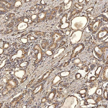 IHC staining of FFPE human prostate adenocarcinoma tissue with SLC25A24 antibody. HIER: boil tissue sections in pH8 EDTA for 20 min and allow to cool before testing.