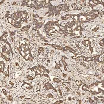 IHC staining of FFPE human lung adenocarcinoma tissue with SLC25A24 antibody. HIER: boil tissue sections in pH8 EDTA for 20 min and allow to cool before testing.