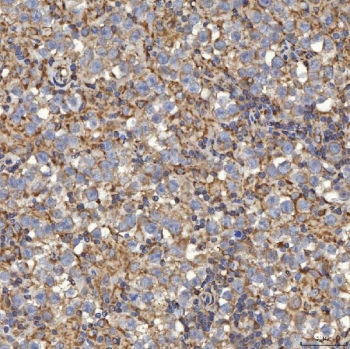IHC staining of FFPE human testicular seminoma tissue with SLC25A24 antibody. HIER: boil tissue sections in pH8 EDTA for 20 min and allow to cool before testing.
