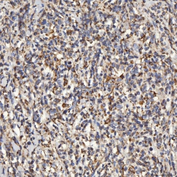 IHC staining of FFPE human diffuse large B cell lymphoma tissue with SLC25A24 antibody. HIER: boil tissue sections in pH8 EDTA for 20 min and allow to cool before testing.