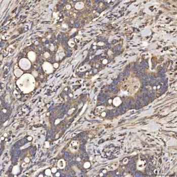 IHC staining of FFPE human duodenal papilla adenocarcinoma tissue with SLC25A24 antibody. HIER: boil tissue sections in pH8 EDTA for 20 min and allow to cool before testing.