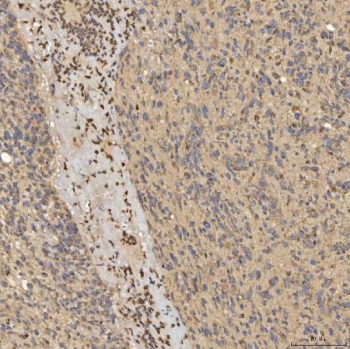 IHC staining of FFPE human glioblastoma tissue with SLC25A24 antibody. HIER: boil tissue sections in pH8 EDTA for 20 min and allow to cool before testing.