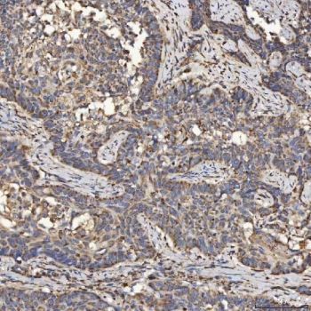 IHC staining of FFPE human larynx squamous cell carcinoma tissue with SLC25A24 antibody. HIER: boil tissue sections in pH8 EDTA for 20 min and allow to cool before testing.