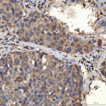 IHC staining of FFPE human liver cancer tissue with SLC25A24 antibody. HIER: boil tissue sections in pH8 EDTA for 20 min and allow to cool before testing.