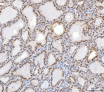 IHC staining of FFPE human thyroid cancer tissue with Transcription factor SP1 antibody. HIER: boil tissue sections in pH8 EDTA for 20 min and allow to cool before testing.