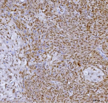 IHC staining of FFPE human lung cancer tissue with Transcription factor SP1 antibody. HIER: boil tissue sections in pH8 EDTA for 20 min and allow to cool before testing.