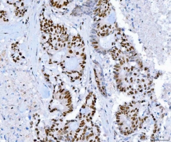 IHC staining of FFPE human colorectal adenocarcinoma tissue with Transcription factor SP1 antibody. HIER: boil tissue sections in pH8 EDTA for 20 min and allow to cool before testing.