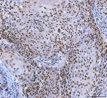 IHC staining of FFPE human laryngeal squamous cell carcinoma tissue with Transcription factor SP1 antibody. HIER: boil tissue sections in pH8 EDTA for 20 min and allow to cool before testing.