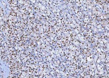 IHC staining of FFPE human glioma tissue with Transcription factor SP1 antibody. HIER: boil tissue sections in pH8 EDTA for 20 min and allow to cool before testing.