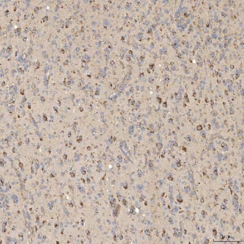 IHC staining of FFPE human glioblastoma tissue with SIAE antibody. HIER: boil tissue sections in pH8 EDTA for 20 min and allow to cool before testing.