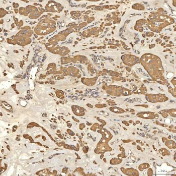 IHC staining of FFPE human right renal oncocytoma tissue with Citrin antibody. HIER: boil tissue sections in pH8 EDTA for 20 min and allow to cool before testing.