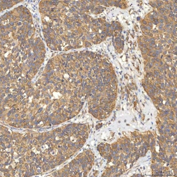 IHC staining of FFPE human urothelial carcinoma tissue with Citrin antibody. HIER: boil tissue sections in pH8 EDTA for 20 min and allow to cool before testing.