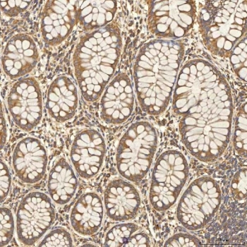 IHC staining of FFPE human colon adenocarcinoma tissue with Citrin antibody. HIER: boil tissue sections in pH8 EDTA for 20 min and allow to cool before testing.