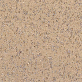 IHC staining of FFPE human glioblastoma tissue with Thiosulfate sulfurtransferase antibody. HIER: boil tissue sections in pH8 EDTA for 20 min and allow to cool before testing.