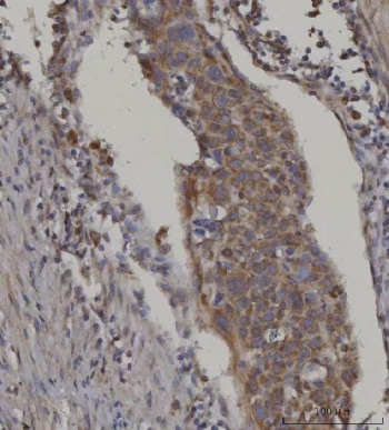 IHC staining of FFPE human esophageal squamous carcinoma tissue with FATP-3 antibody. HIER: boil tissue sections in pH8 EDTA for 20 min and allow to cool before testing.