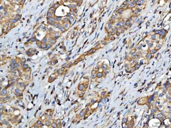 IHC staining of FFPE human colorectal adenocarcinoma tissue with FATP-4 antibody. HIER: boil tissue sections in pH8 EDTA for 20 min and allow to cool before testing.