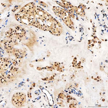 IHC staining of FFPE human right renal oncocytoma tissue with SNF2L2 antibody. HIER: boil tissue sections in pH8 EDTA for 20 min and allow to cool before testing.