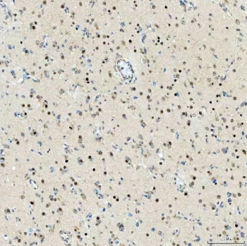 IHC staining of FFPE human glioblastoma tissue with SNF2L2 antibody. HIER: boil tissue sections in pH8 EDTA for 20 min and allow to cool before testing.