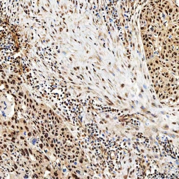 IHC staining of FFPE human esophageal squamous carcinoma tissue with SNF2H antibody. HIER: boil tissue sections in pH8 EDTA for 20 min and allow to cool before testing.