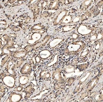 IHC staining of FFPE human prostate adenocarcinoma tissue with PAO-1 antibody. HIER: boil tissue sections in pH8 EDTA for 20 min and allow to cool before testing.