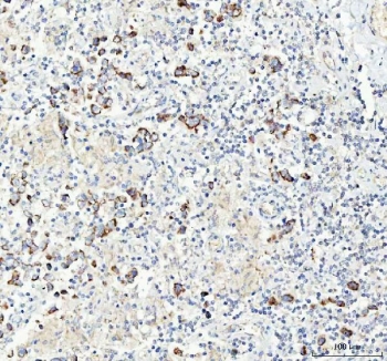 IHC staining of FFPE human testicular germ cell tumor tissue with CHGA antibody. HIER: boil tissue sections in pH8 EDTA for 20 min and allow to cool before testing.