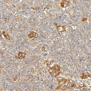 IHC staining of FFPE human larynx squamous cell carcinoma tissue with Syntaphilin antibody. HIER: boil tissue sections in pH8 EDTA for 20 min and allow to cool before testing.