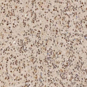IHC staining of FFPE human glioblastoma tissue with SNRNP40 antibody. HIER: boil tissue sections in pH8 EDTA for 20 min and allow to cool before testing.