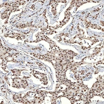 IHC staining of FFPE human breast cancer tissue with SNRNP40 antibody. HIER: boil tissue sections in pH8 EDTA for 20 min and allow to cool before testing.