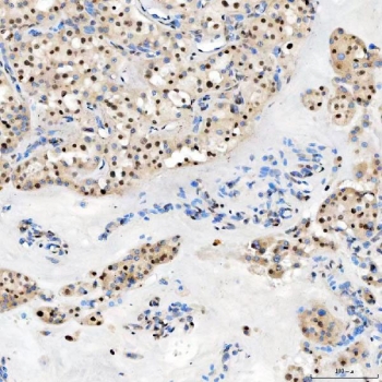 IHC staining of FFPE human right renal oncocytoma tissue with U1 snRNP C antibody. HIER: boil tissue sections in pH8 EDTA for 20 min and allow to cool before testing.