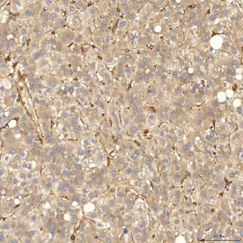 IHC staining of FFPE human liver cancer tissue with Sorting nexin 4 antibody. HIER: boil tissue sections in pH8 EDTA for 20 min and allow to cool before testing.