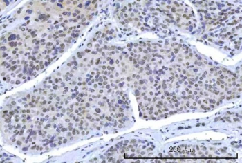 IHC staining of FFPE human liver cancer tissue with OTT3 antibody. HIER: boil tissue sections in pH8 EDTA for 20 min and allow to cool before testing.