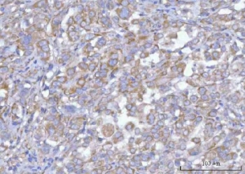 IHC staining of FFPE human lung adenocarcinoma tissue with Hamartin antibody. HIER: boil tissue sections in pH8 EDTA for 20 min and allow to cool before testing.