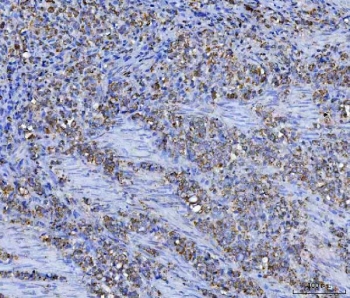 IHC staining of FFPE human gastric carcinoma tissue with ASNS antibody. HIER: boil tissue sections in pH8 EDTA for 20 min and allow to cool before testing.