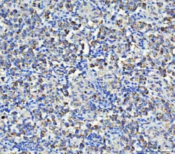 IHC staining of FFPE human testicular germ cell tumor tissue with ASNS antibody. HIER: boil tissue sections in pH8 EDTA for 20 min and allow to cool before testing.