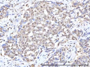 IHC staining of FFPE human lung squamous cell carcinoma tissue with RANBP2 antibody. HIER: boil tissue sections in pH8 EDTA for 20 min and allow to cool before testing.