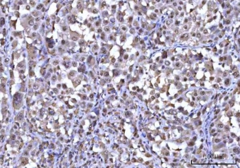 IHC staining of FFPE human lung adenocarcinoma tissue with RNF34 antibody. HIER: boil tissue sections in pH8 EDTA for 20 min and allow to cool before testing.