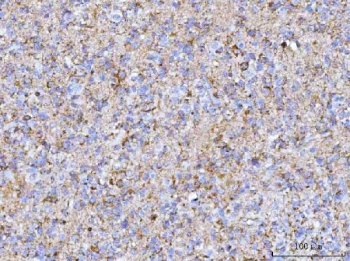 IHC staining of FFPE human glioma tissue with HBBM antibody. HIER: boil tissue sections in pH8 EDTA for 20 min and allow to cool before testing.