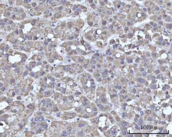 IHC staining of FFPE human liver cancer tissue with SSBP1 antibody. HIER: boil tissue sections in pH8 EDTA for 20 min and allow to cool before testing.