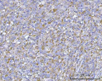 IHC staining of FFPE human intestine diffuse large B-cell lymphoma tissue with PACSIN2 antibody. HIER: boil tissue sections in pH8 EDTA for 20 min and allow to cool before testing.
