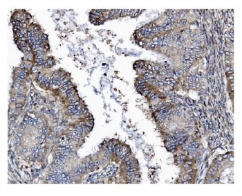 IHC staining of FFPE human cervical intraepithelial neoplasia tissue with GSDMD antibody. HIER: boil tissue sections in pH8 EDTA for 20 min and allow to cool before testing.
